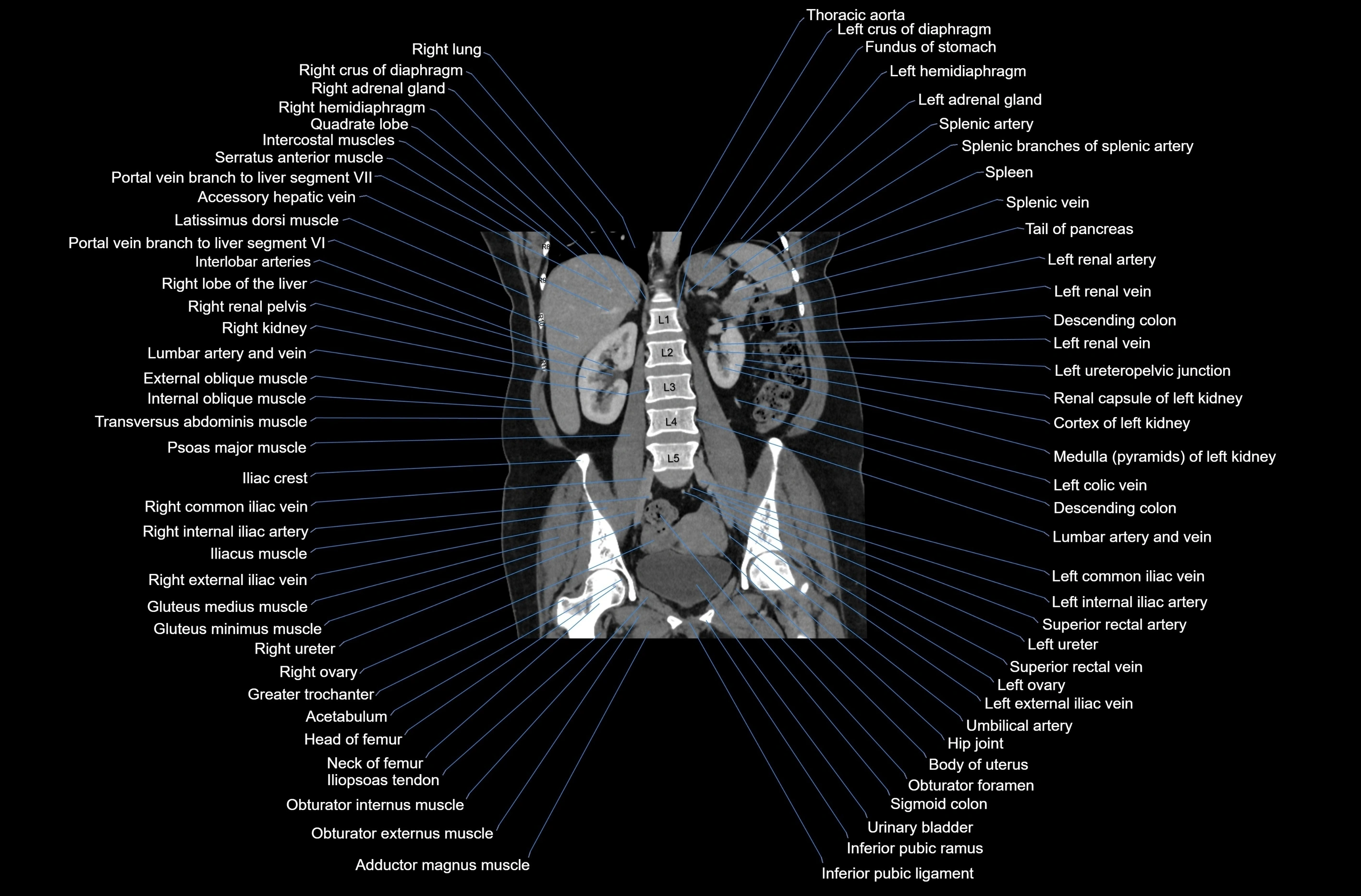 CT abdomen coronal cross sectional anatomy labelled radiology image-00053.webp